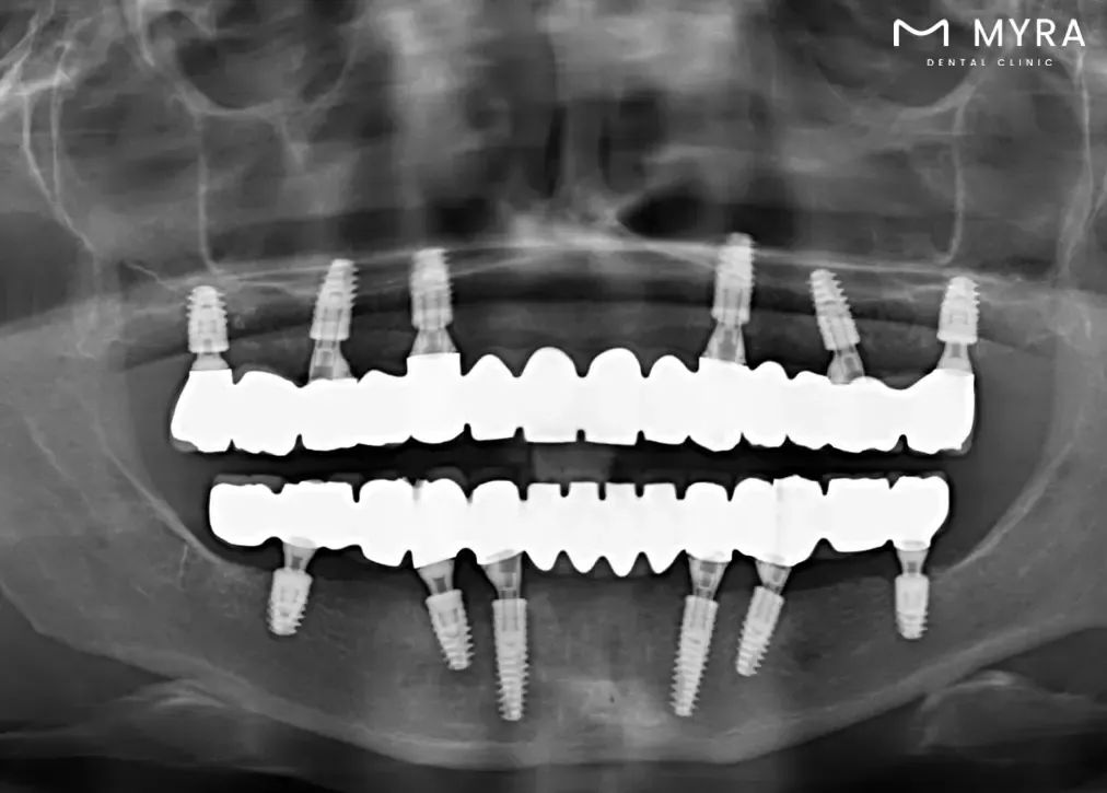 What are the advantages of sirona 3d dental tomography for the patient?