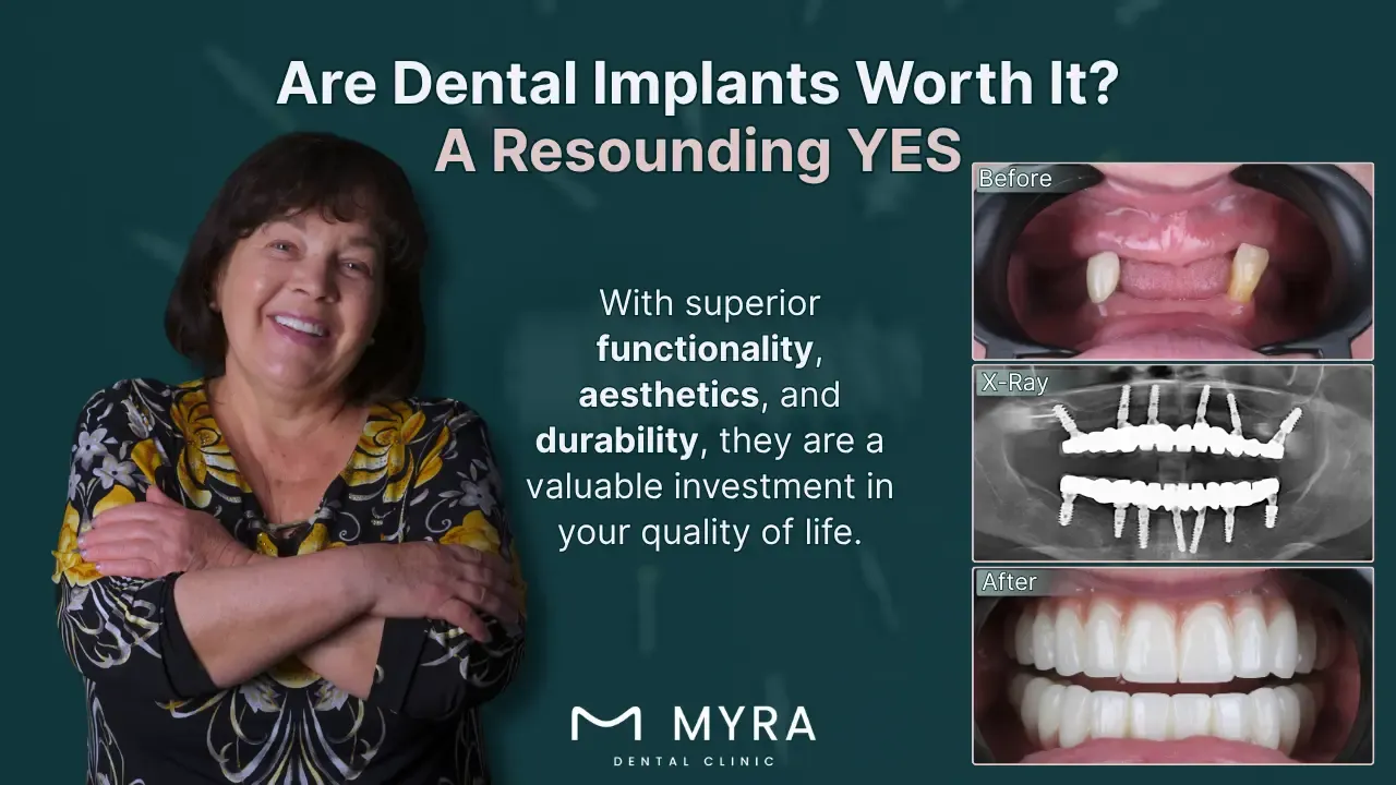 what are the alternatives to dental implants