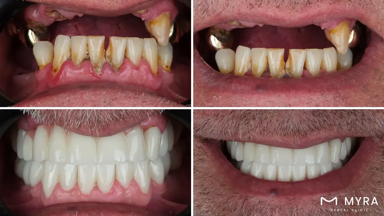 what are the benefits of an immediate load implant?