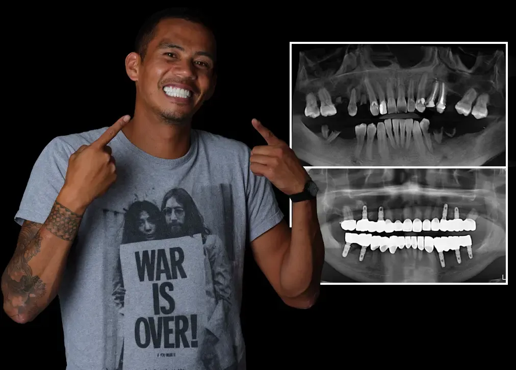 What are the benefits of cosmetic dentures in turkey?