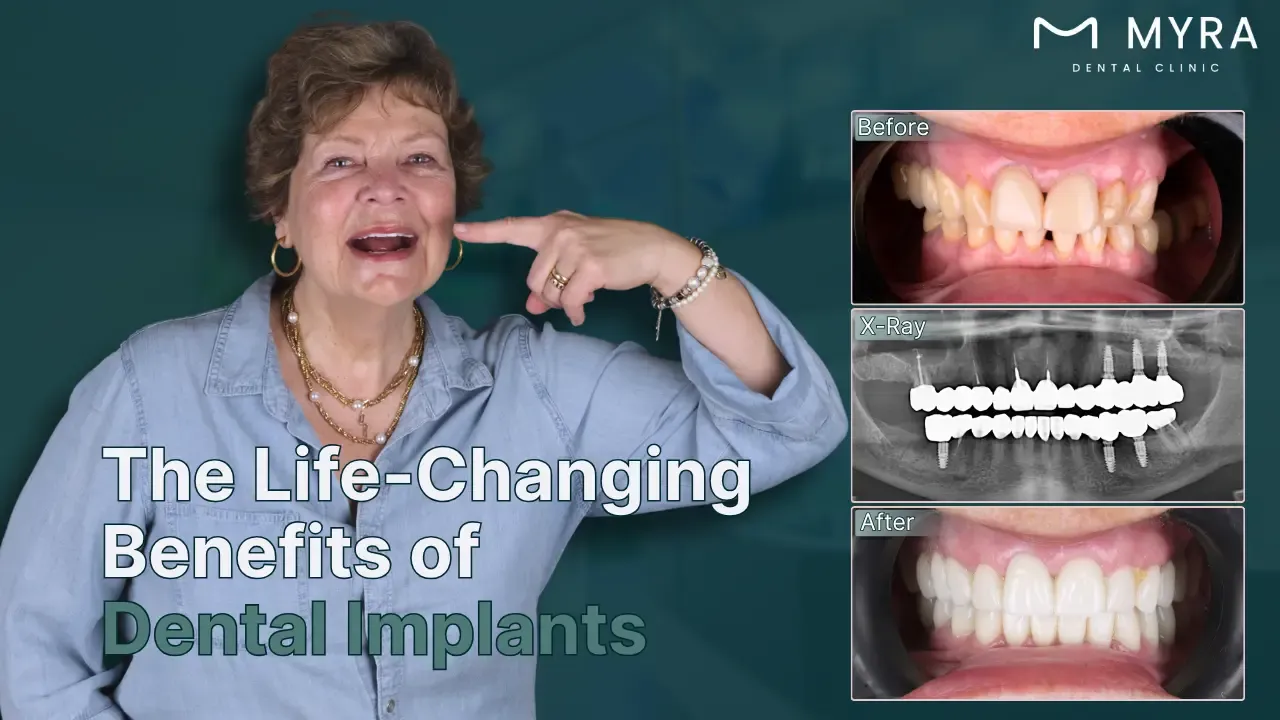what are the benefits of dental implants?