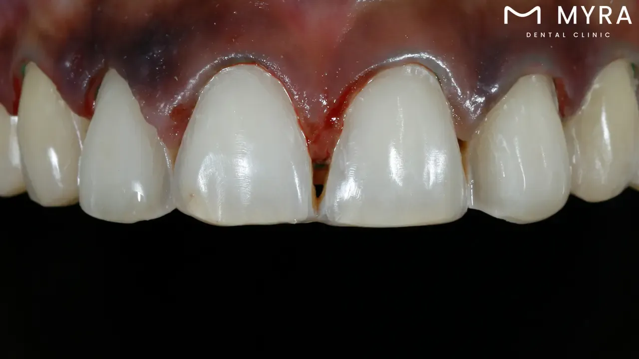 What are the benefits of dental veneers?