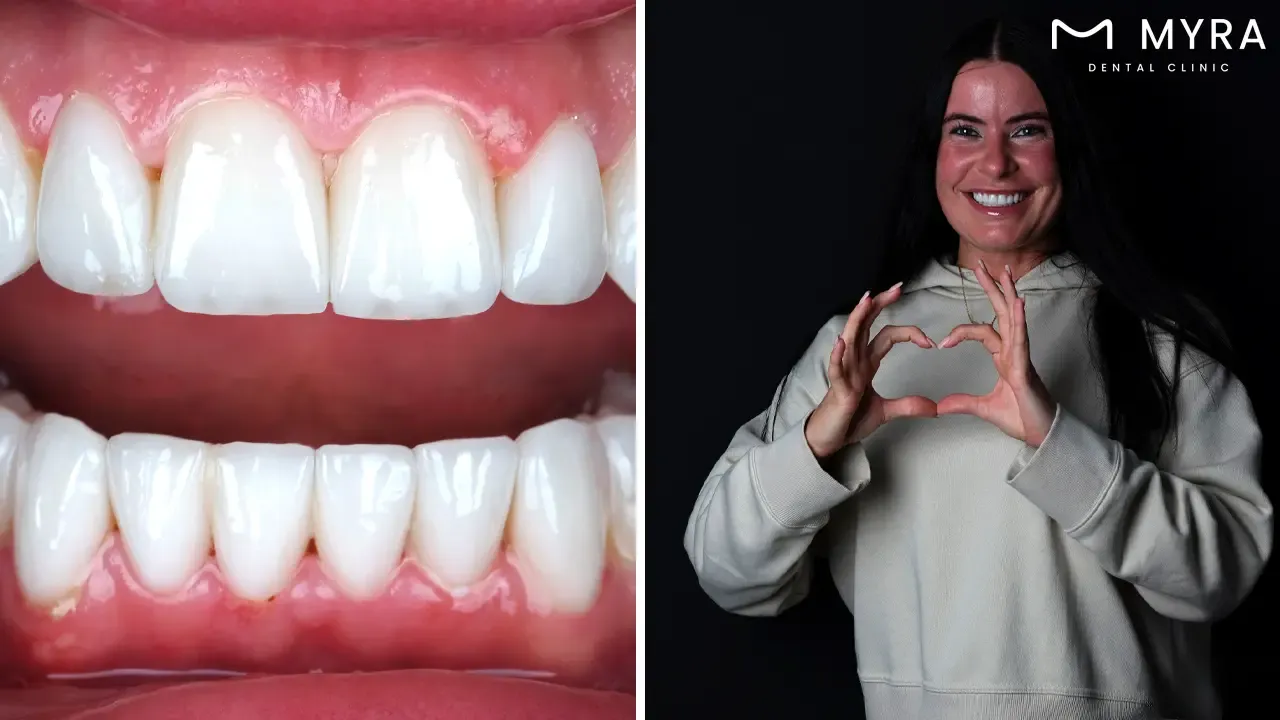 What are the benefits of getting a full set of veneers in turkey?