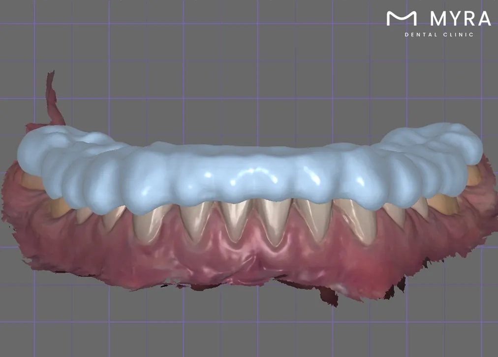 What are the benefits of a gum shield in turkey?