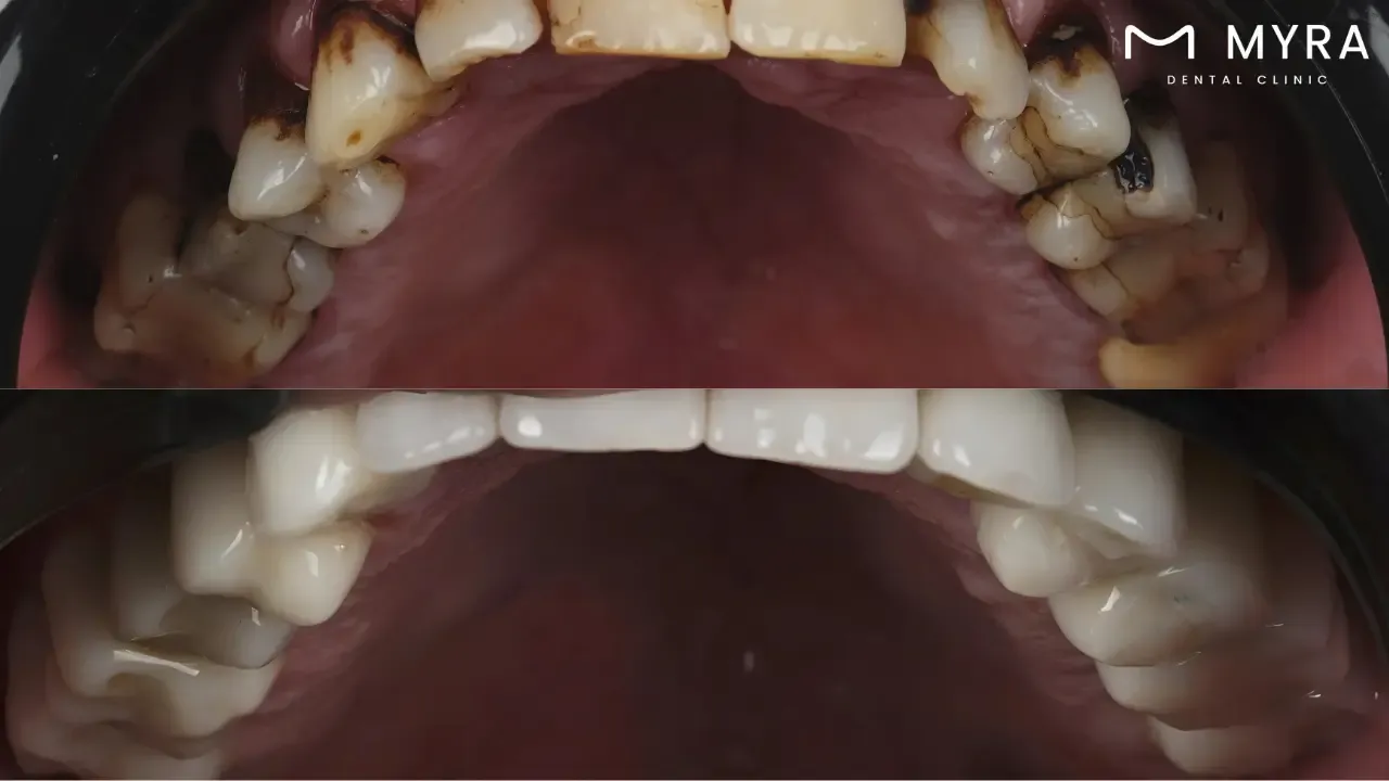 What are the causes of cavities?