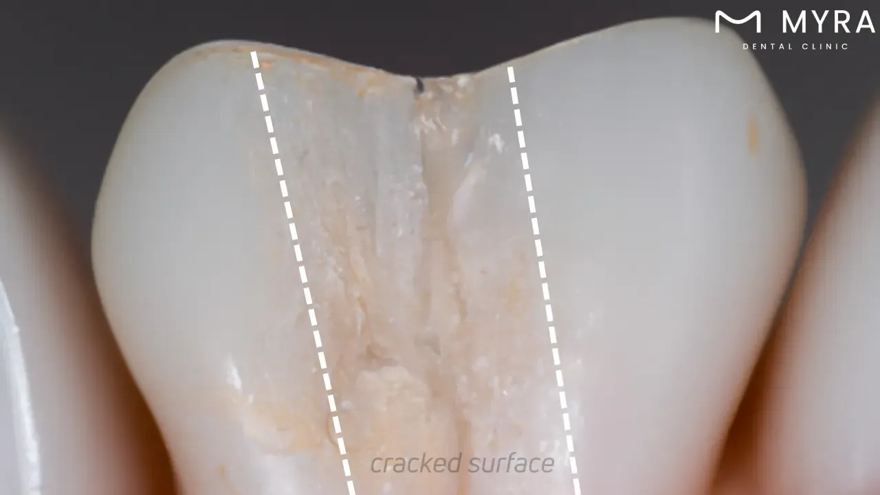 What are the causes of a cracked tooth?