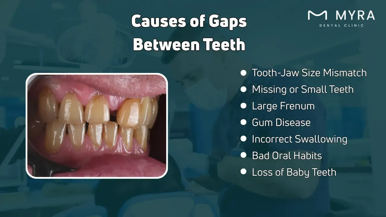 What are the causes of a gap between teeth?