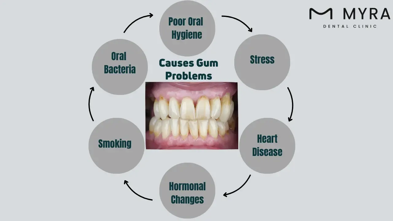 What are the causes of gum problems?