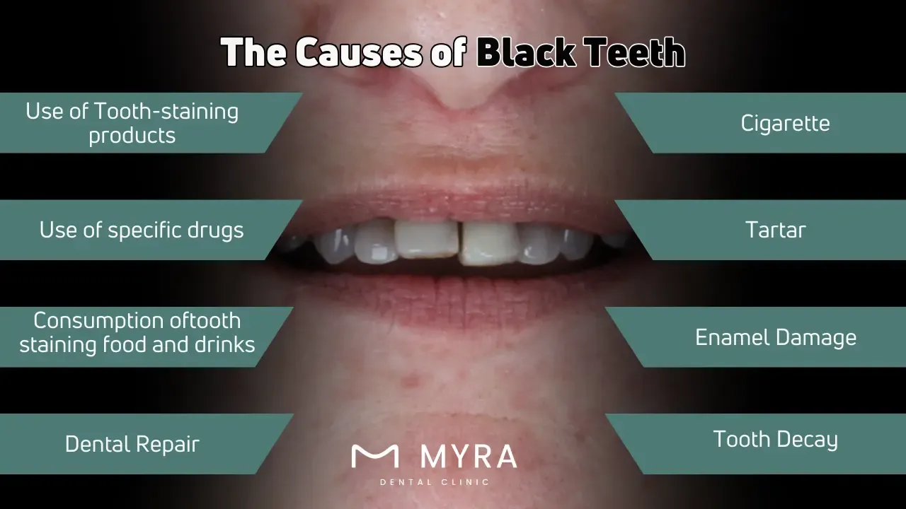 What are the causes of black teeth?