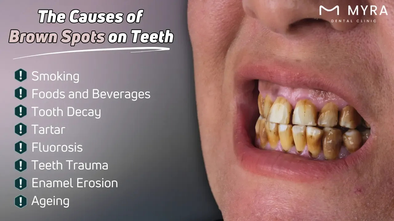 What are the causes of brown spots on teeth?