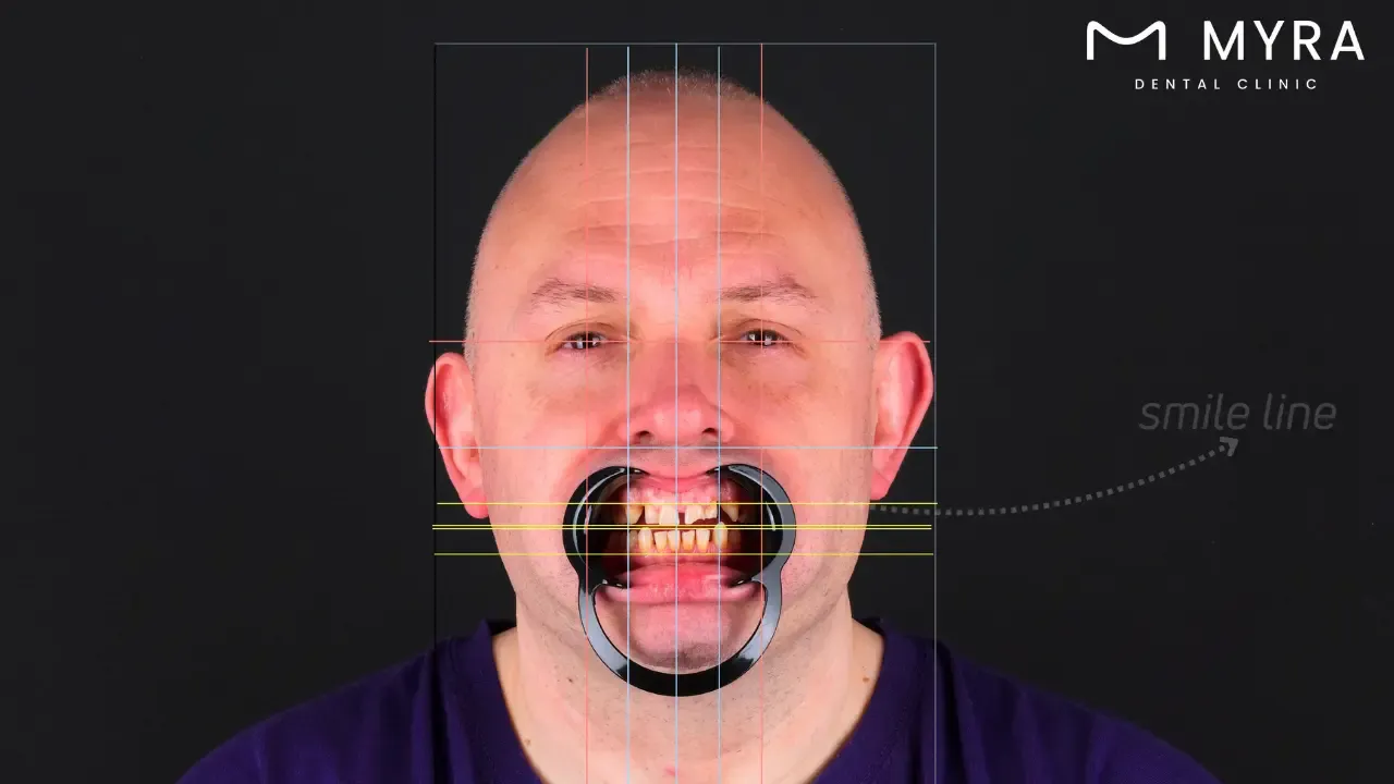 What are the causes of diastema?
