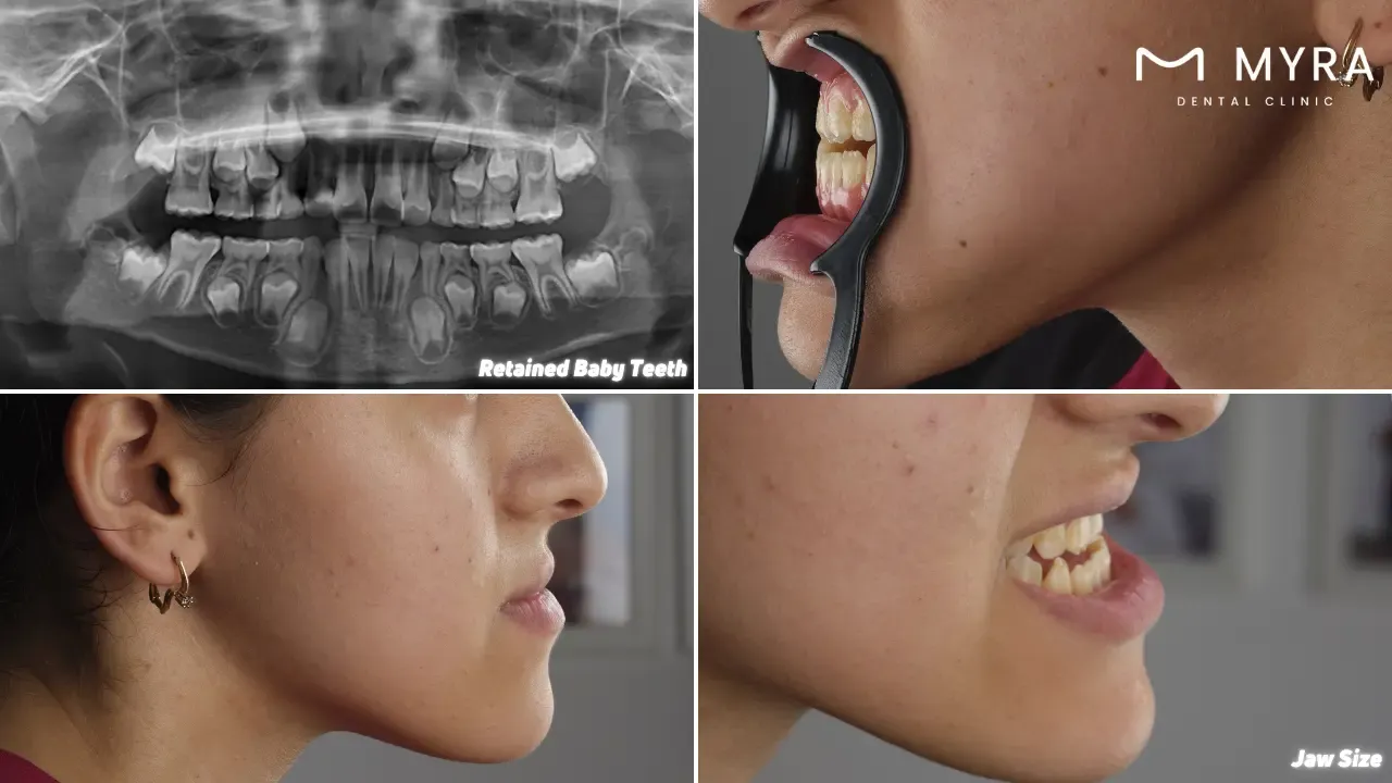 What are the causes of impacted teeth?