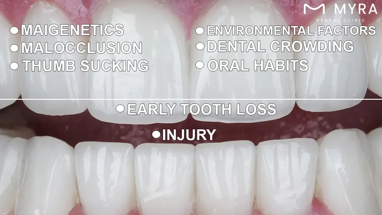 What are the causes of a narrow smile?