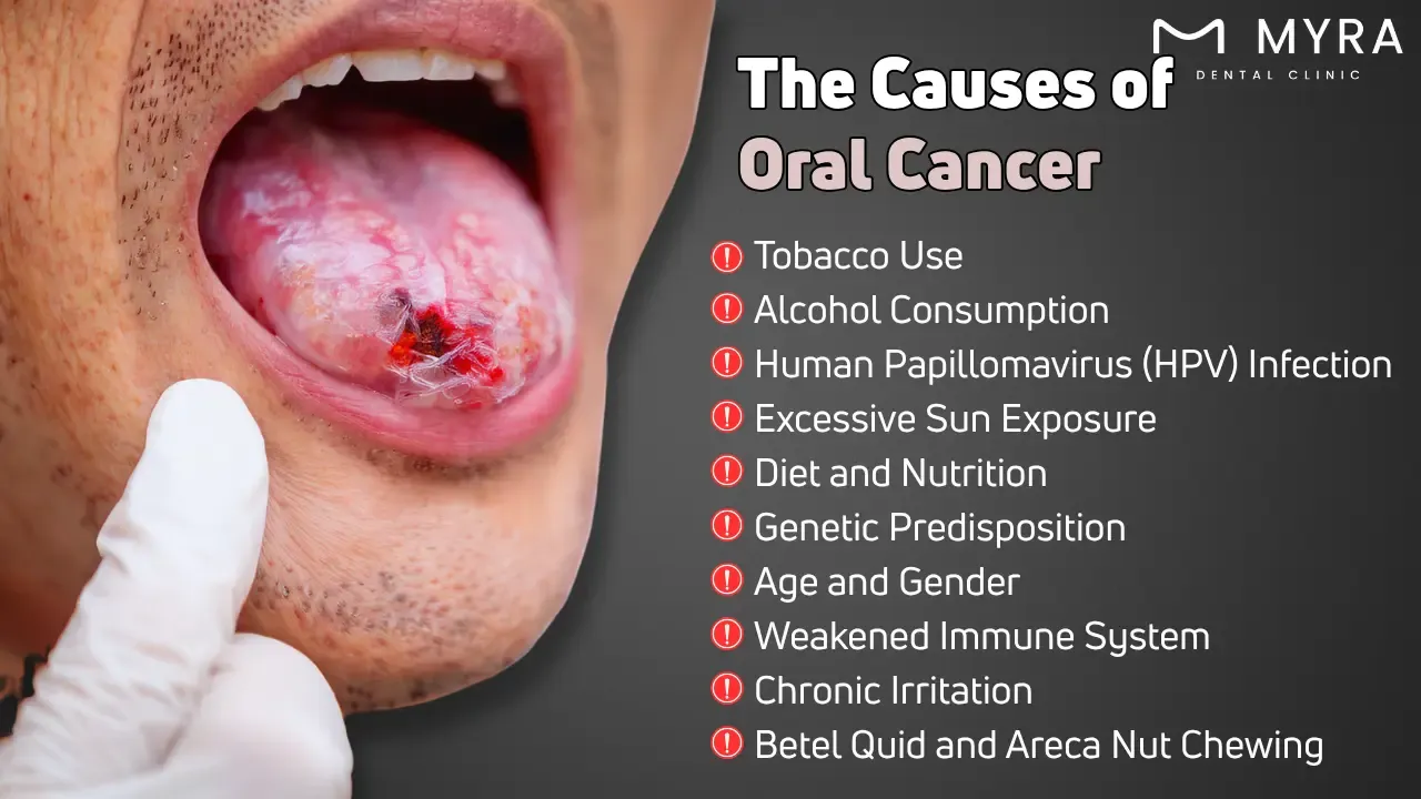 What are the causes of oral cancer?