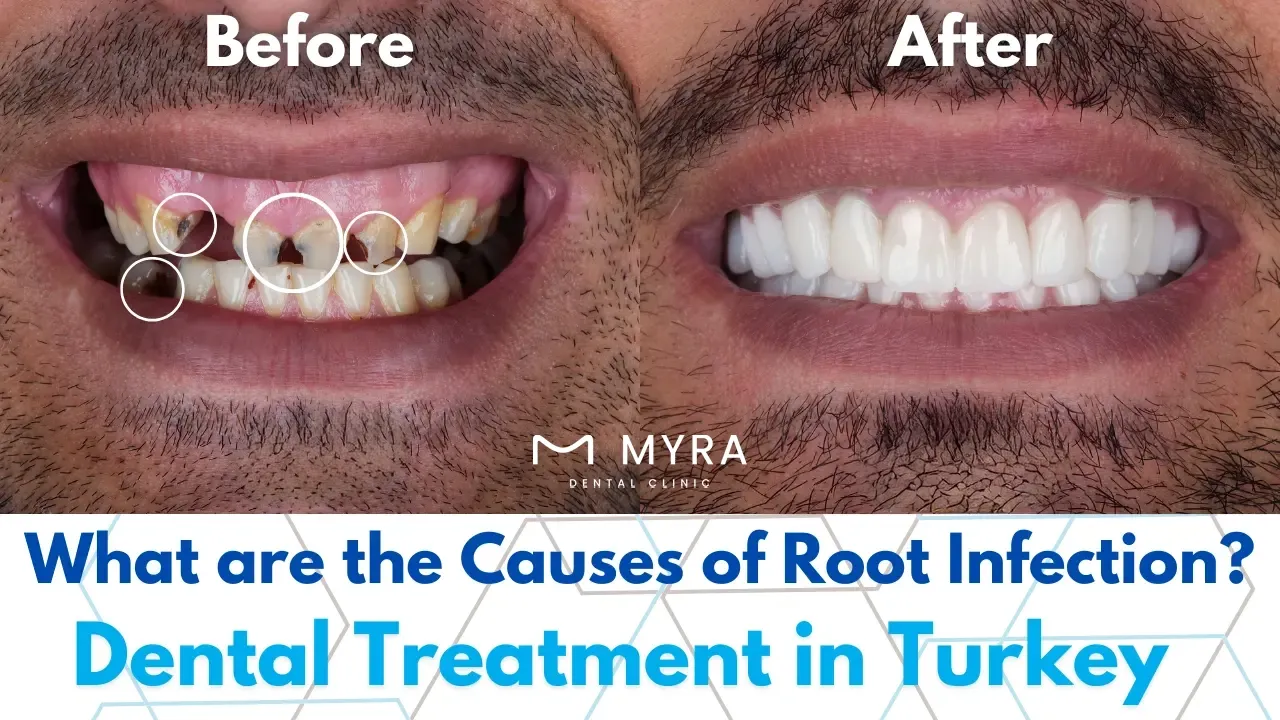 What are the causes of root infection in turkey?