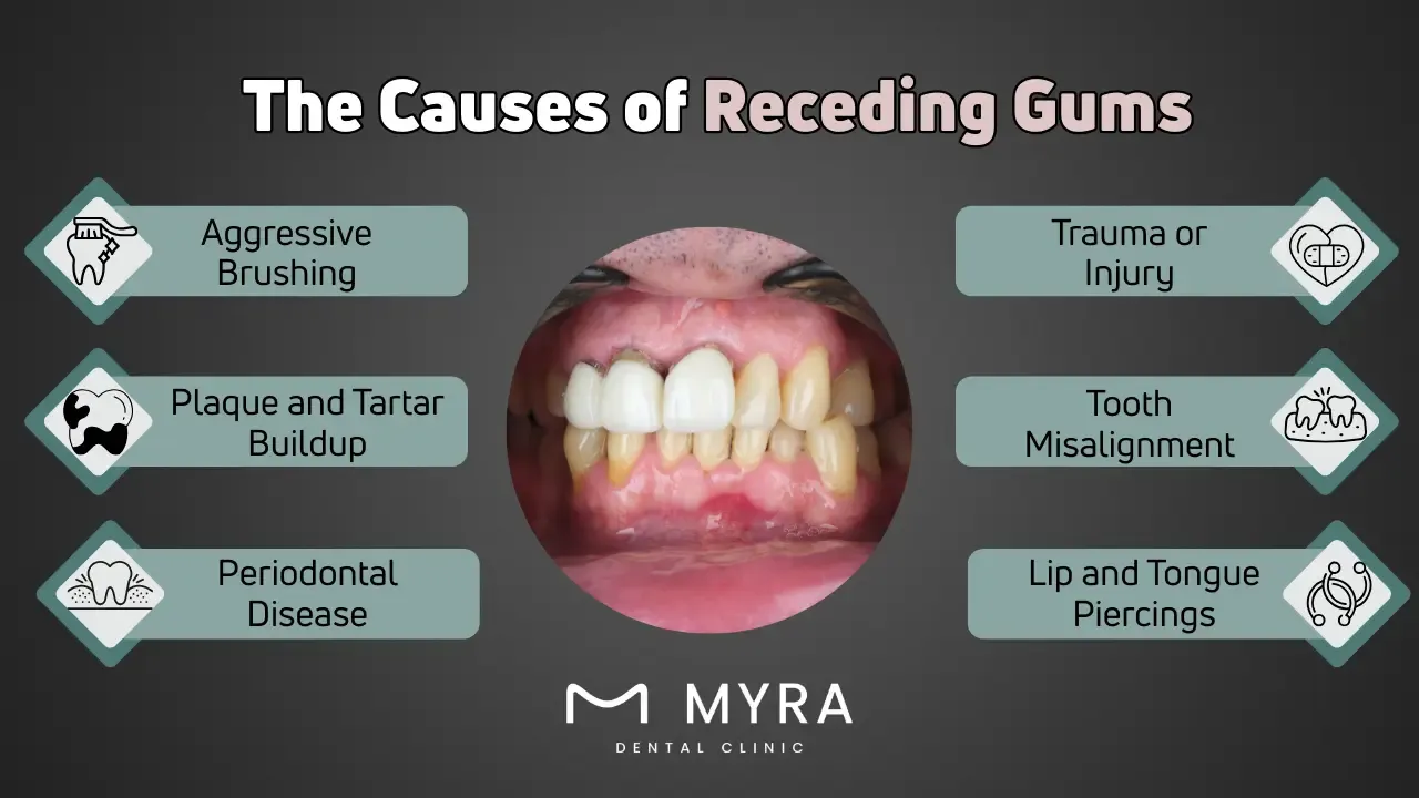 What are the causes of receding gums?