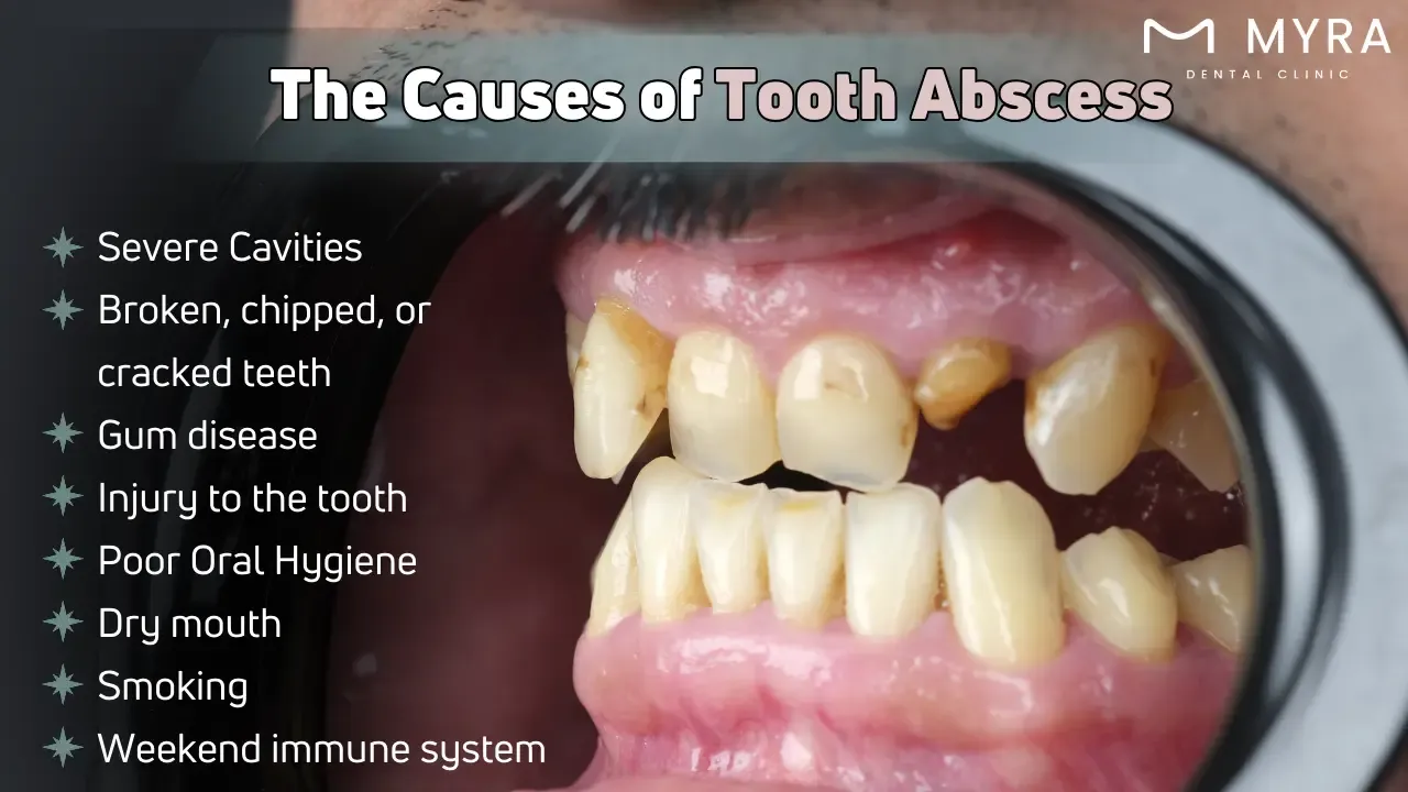 What are the causes of a tooth abscess?