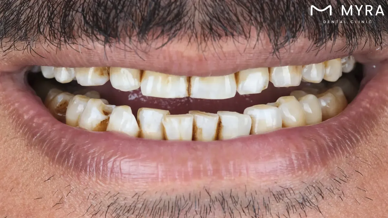 What are the causes of tooth decay?