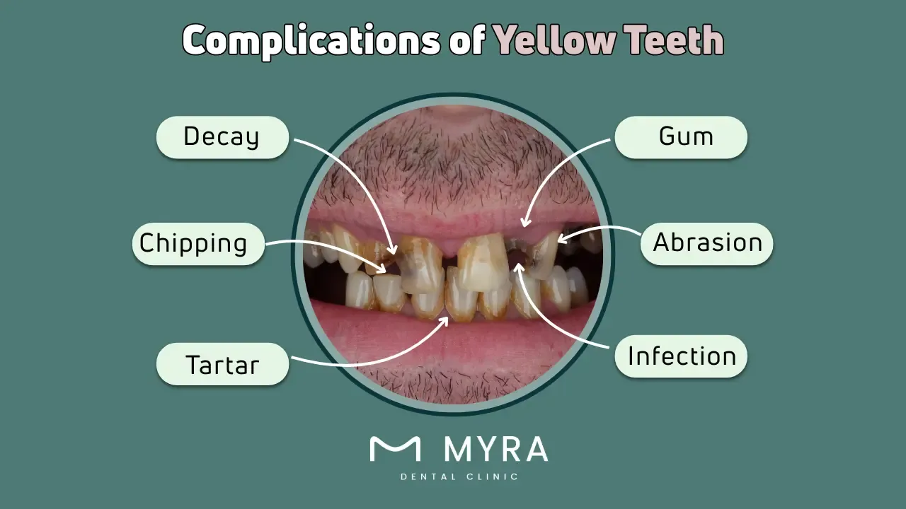 What are the complications of yellow teeth?