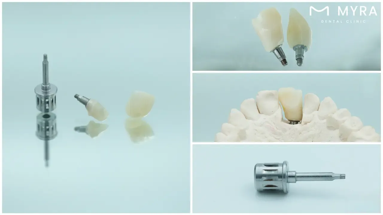 what are the components of a single tooth dental implant