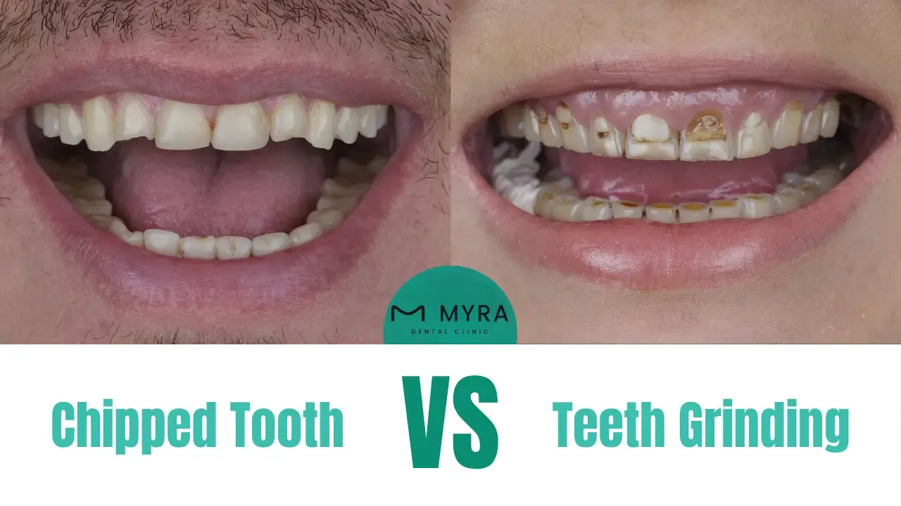 What is the difference between a chipped tooth and teeth grinding?