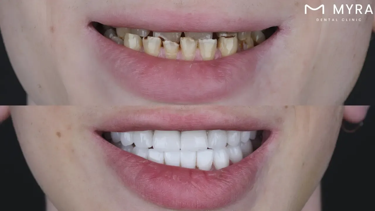 What is the difference between a cracked tooth and crooked teeth?