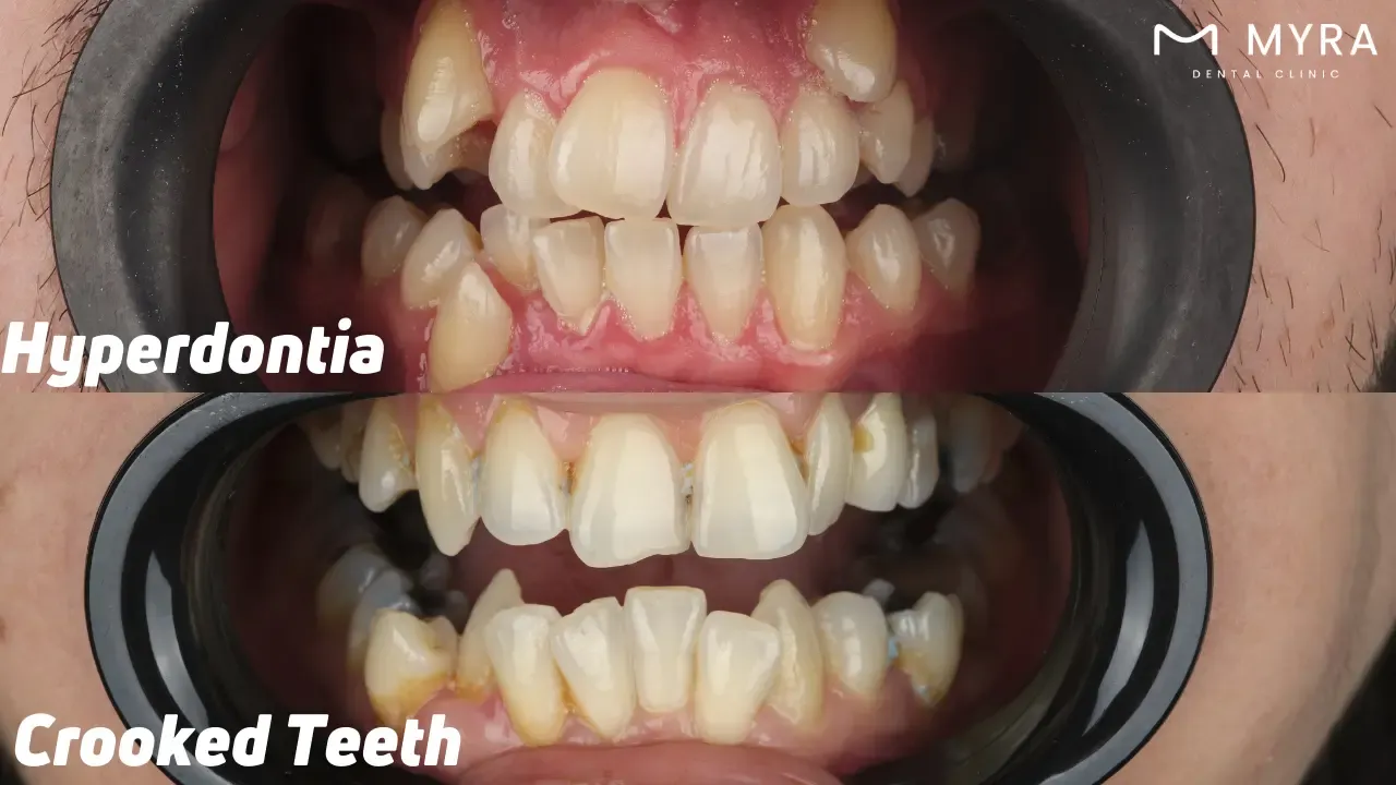 Misalignment vs. extra teeth: What's the difference?