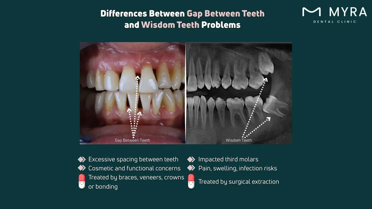 What is the difference between a gap between teeth and wisdom teeth problems?