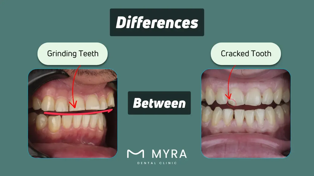 What is the difference between grinding teeth and a cracked tooth?