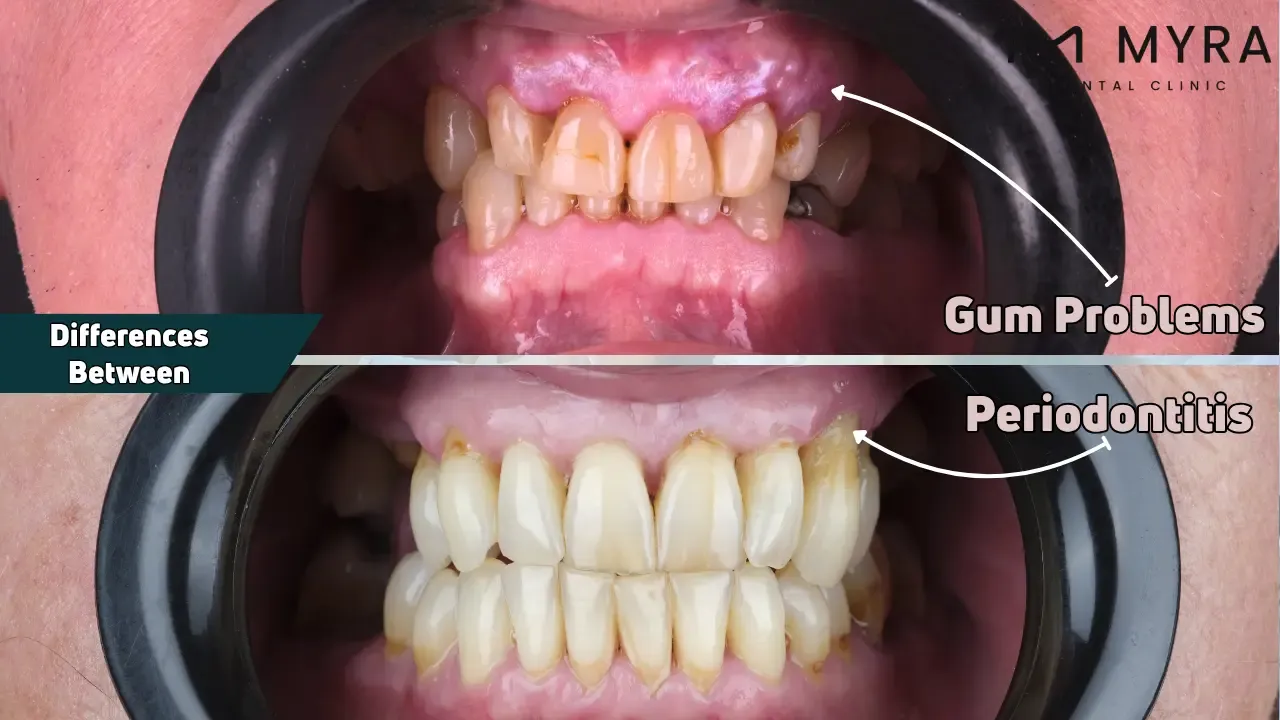 What are the differences between gum problems and periodontitis?