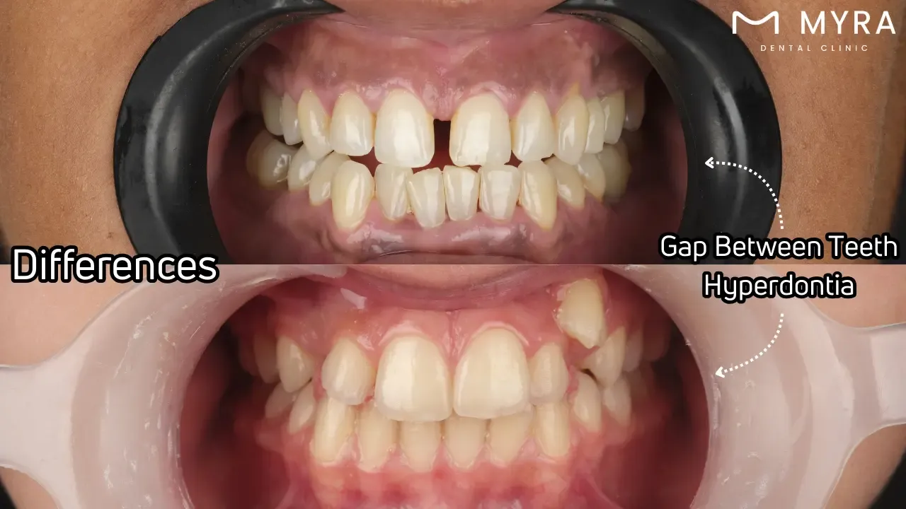 What is the difference between hyperdontia and a gap between teeth?