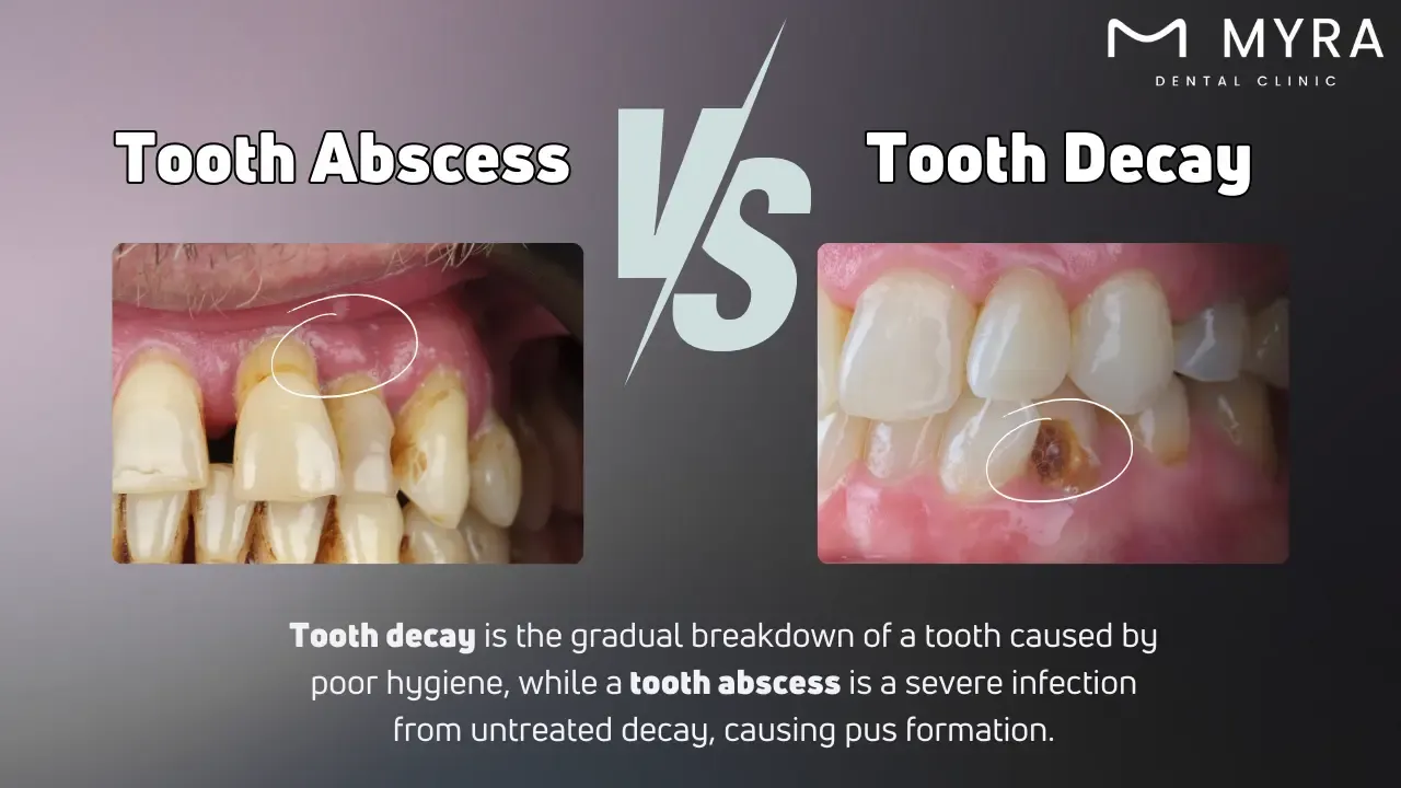 What is the difference between a tooth abscess and tooth decay?