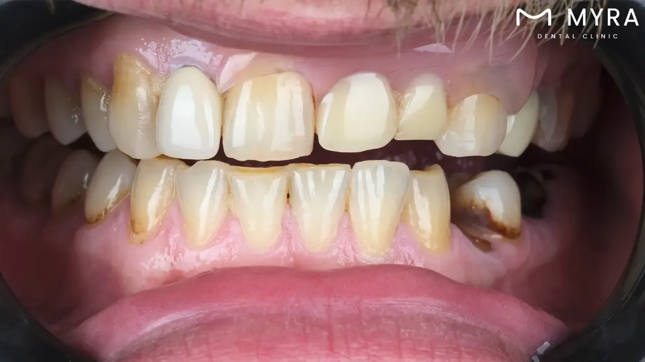 What is the difference between tooth decay and bad breath?