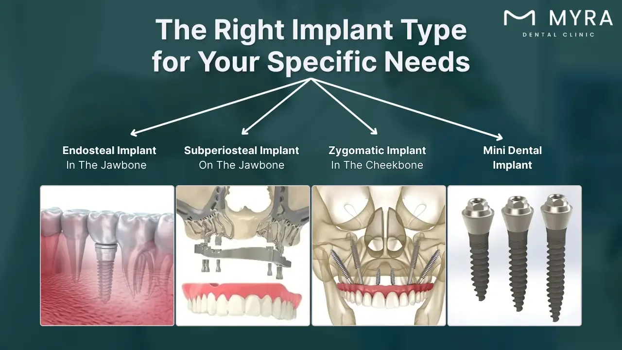 what are the different types of tooth implants