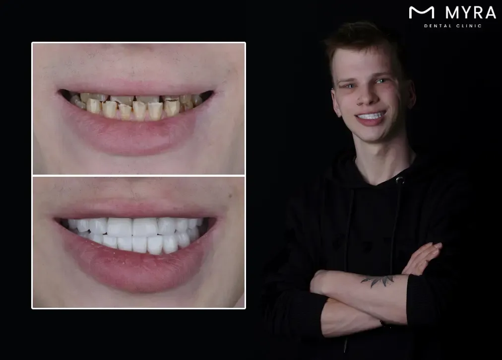 What are the disadvantages of zirconia veneers from other types