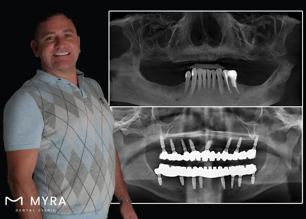What are the downsides of tooth extraction in turkey?