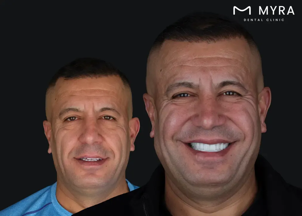 What are the ethical implications of getting veneers according to islamic teachings