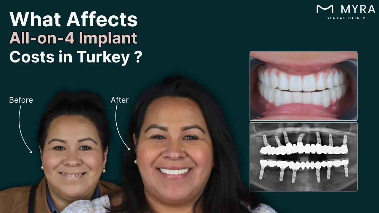 what-are-the-factors-affecting-the-cost-of-all-on-4-implants-in-turkey.webp