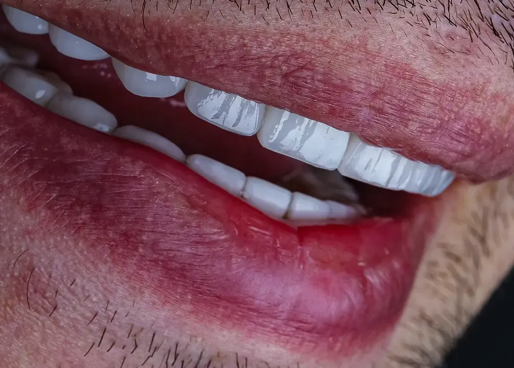 What are the factors affecting the cost of dental crowns in turkey?