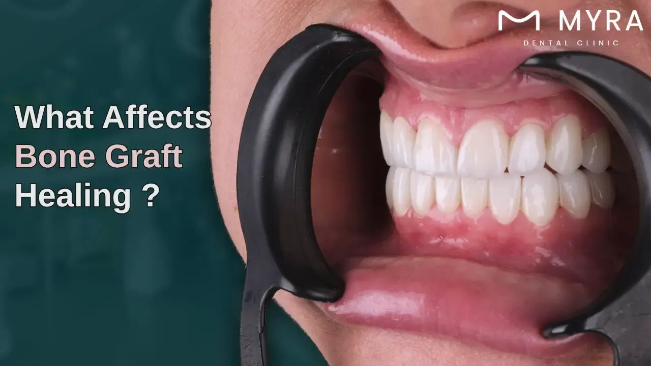 what are the factors affecting the healing stages of dental bone grafts?