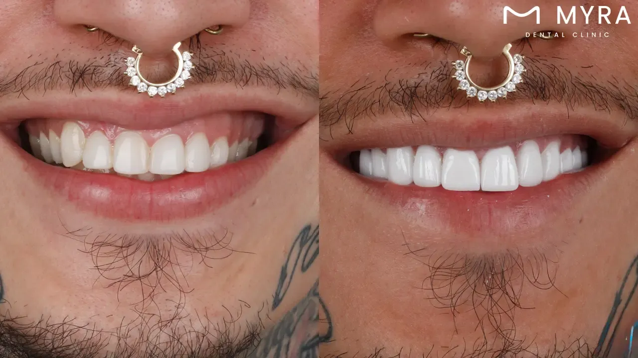 What are the materials used in dental laminates?