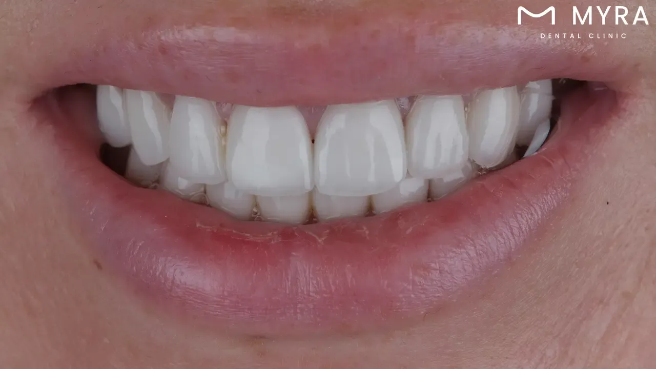 What are the materials used in dental veneers?