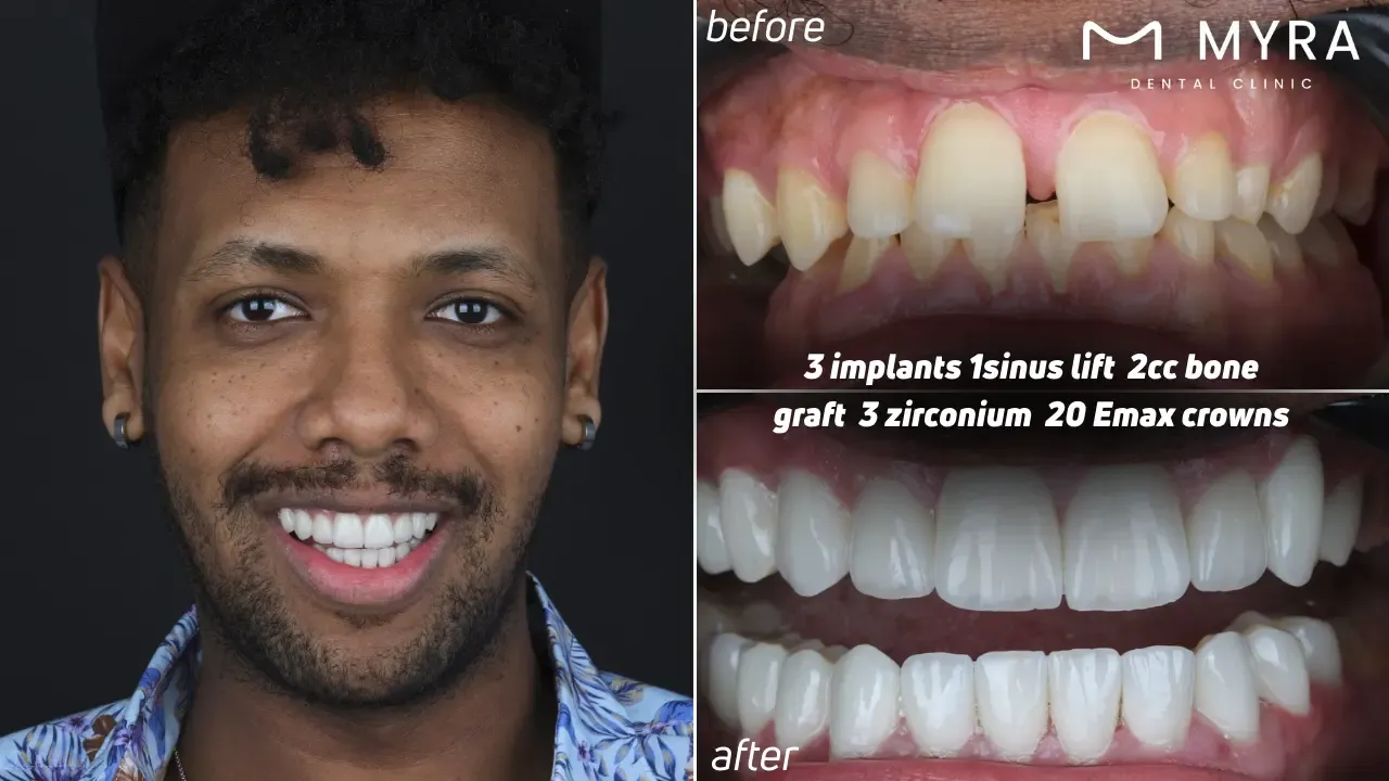 What are the options for treating diastema?