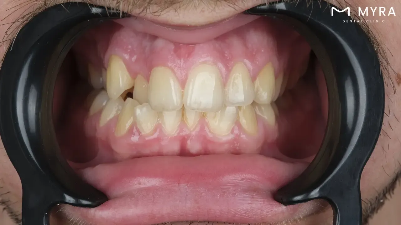 What does research say about crooked teeth?