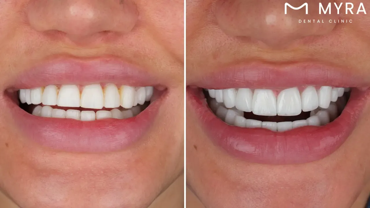 What are the risks of dental veneers?