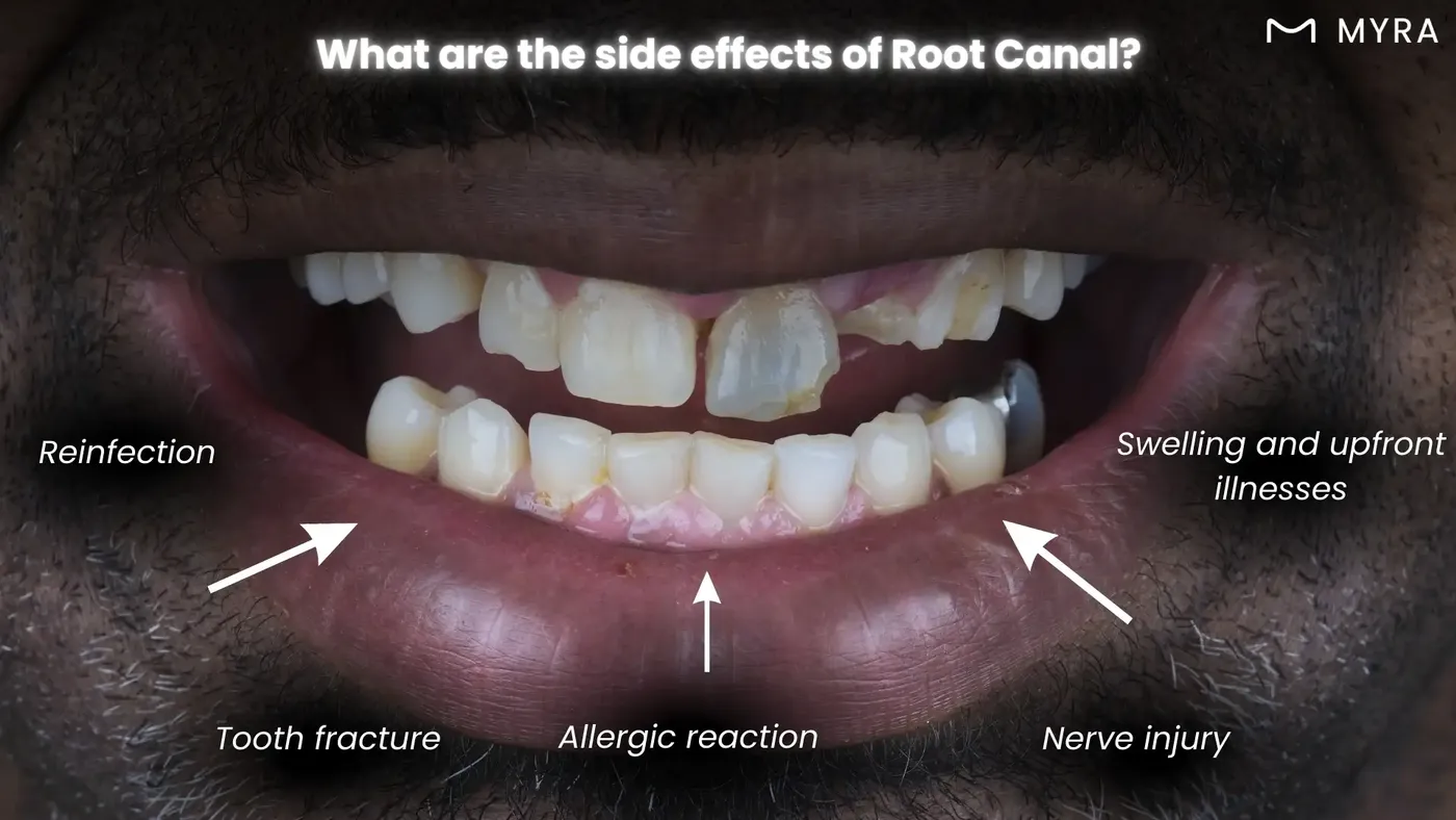 what are the side effects of a root canal?