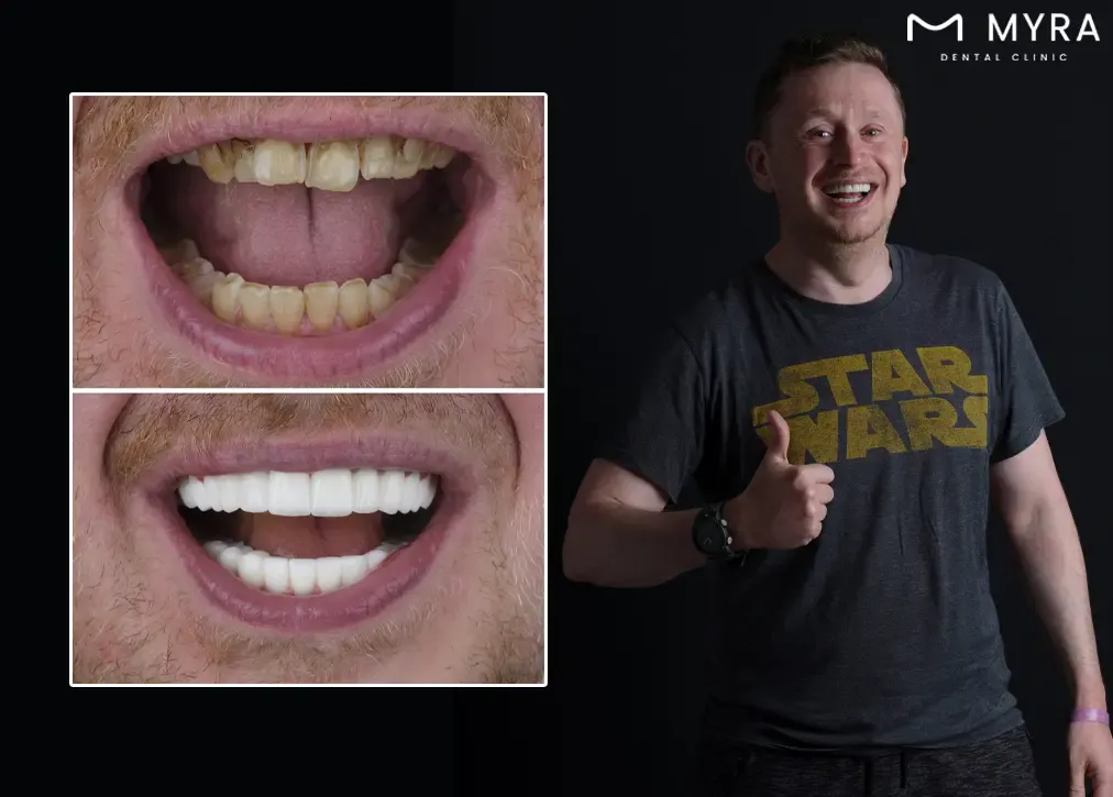 What are the signs that indicate zirconia veneers may need replacement