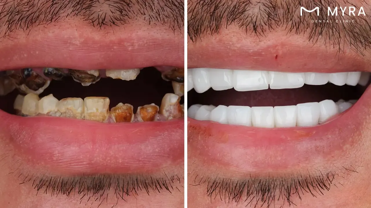 What are the symptoms of cavities?