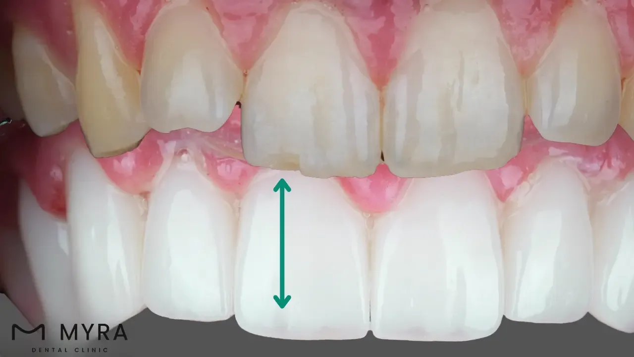 What are the symptoms of a chipped tooth in turkey?