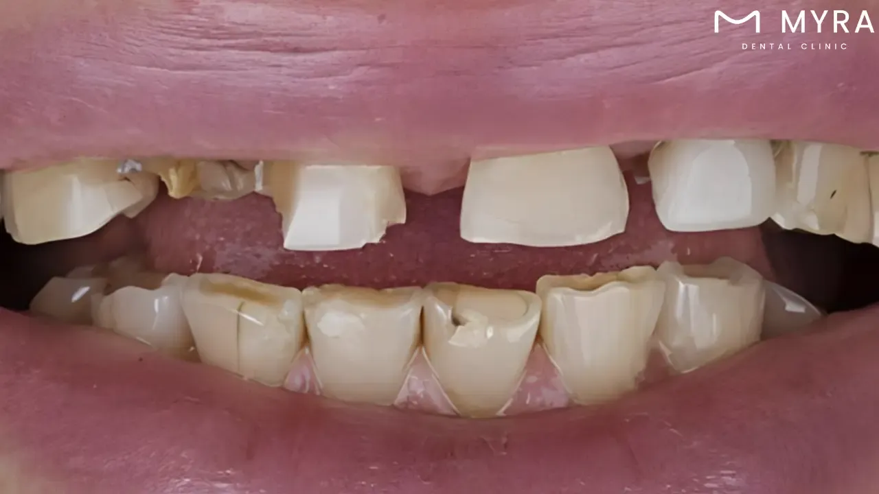 What are the symptoms of a cracked tooth?